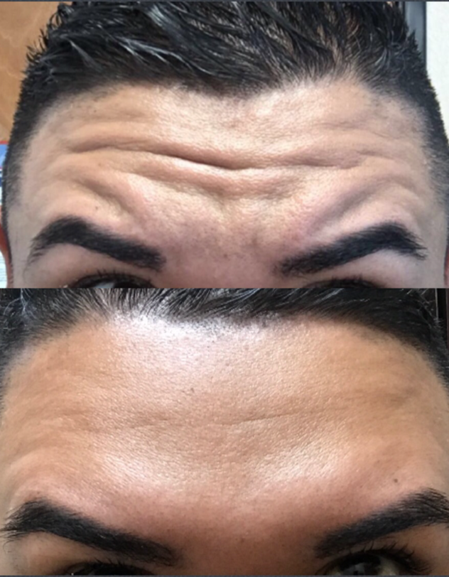 Botox