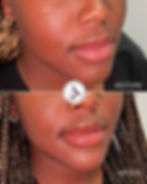 Lip Filler