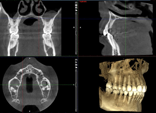 scanner 3D pour implant dentaire