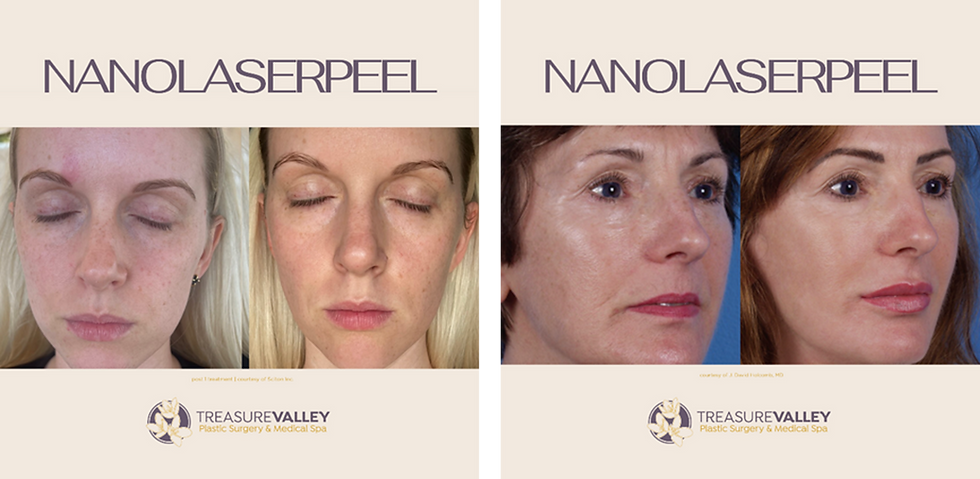 Nano Laser Peel before and after images