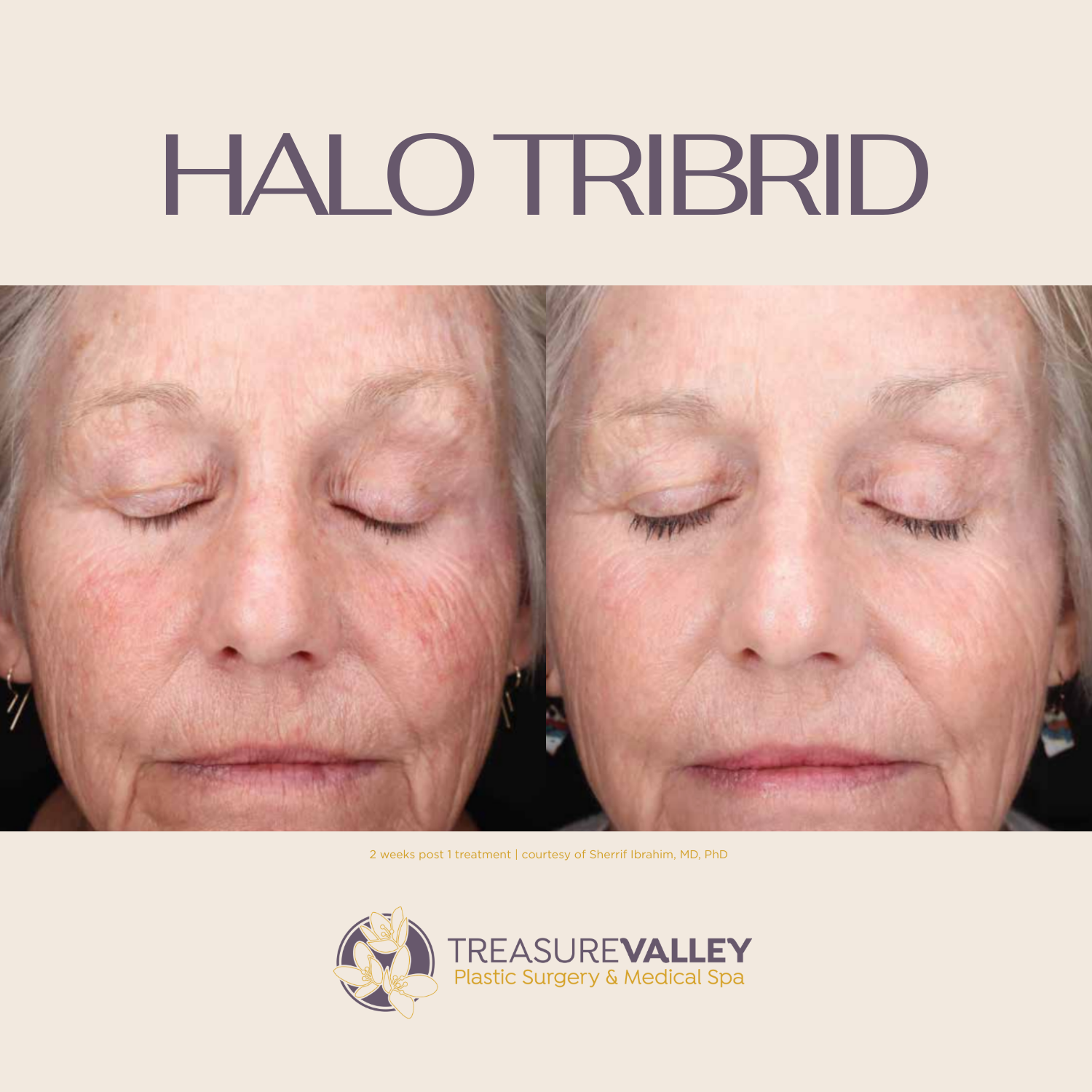 Treasure Valley Medical Spa Announces the Arrival of the HALO Tribrid Laser