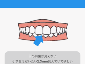 過蓋咬合