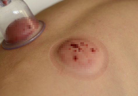 カッピングは、流血しません。