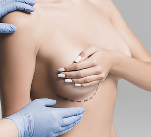 a picture of woman having breast lift