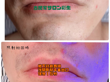 🥸脱毛パパ日記✏️