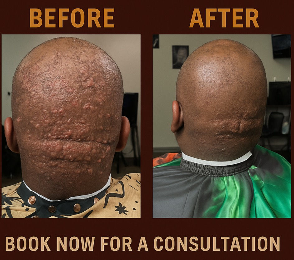 Why Black Men Get Razor Bumps More Often (and How to Prevent Them)