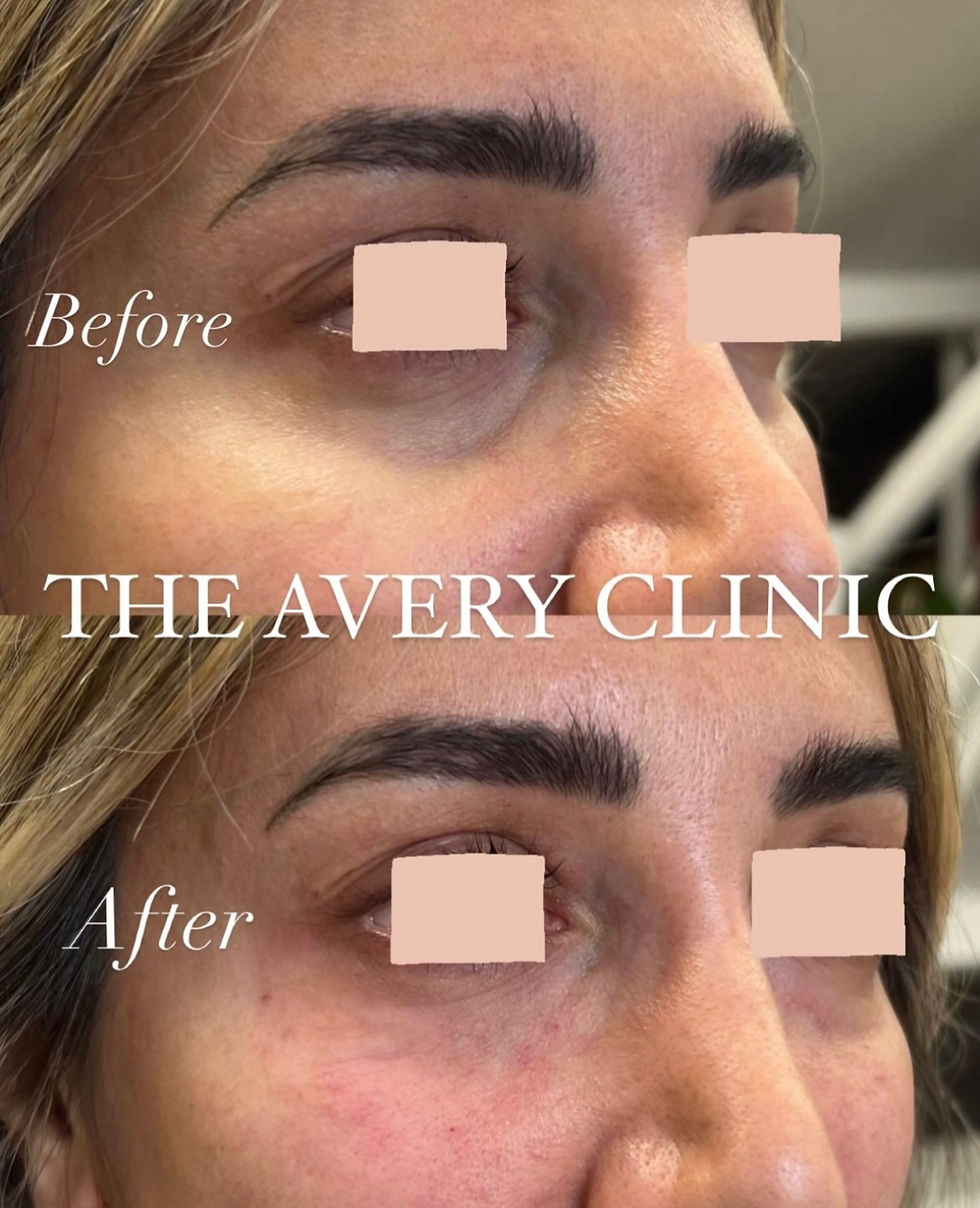 Tear Trough filler, Leamington Spa, Warwickshire