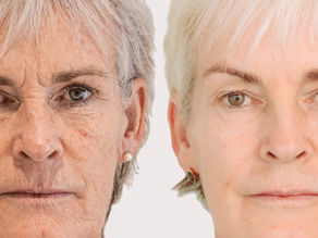 Morpheus 8: The Skin Tightening Treatment Celebrities Swear By