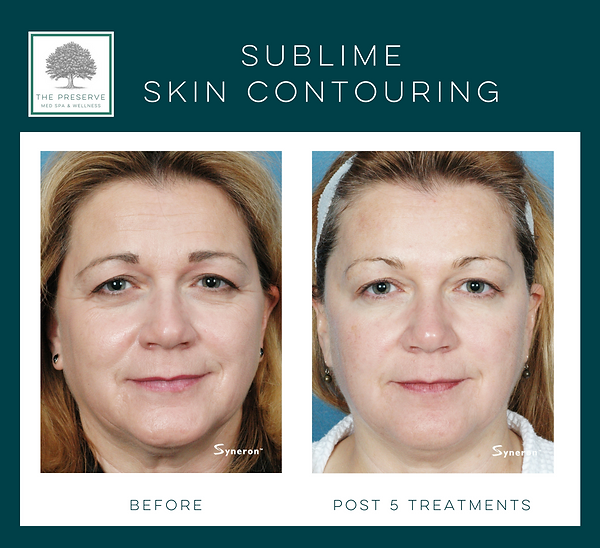 Fort Worth Medspa Skin tightening, skin contouring, radiofreqency safe for all skin types