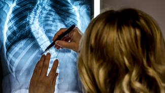 Tratamento conservador da Escoliose Idiopática – Método Schroth