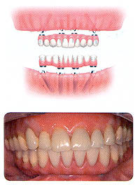 All-on-4(オール・オン・フォー)