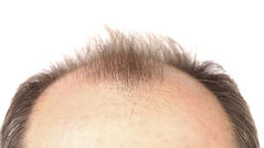 pattern Baldness.jpeg
