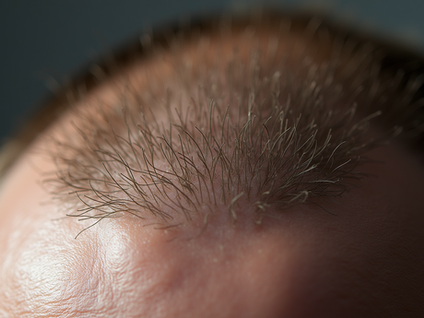 Achieve Hair Regrowth with Proven Methods