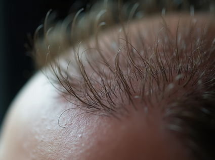 Best Thinning Hair Remedies: Top Solutions for Hair Thinning