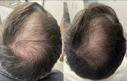 PRF Hair restoration treatment