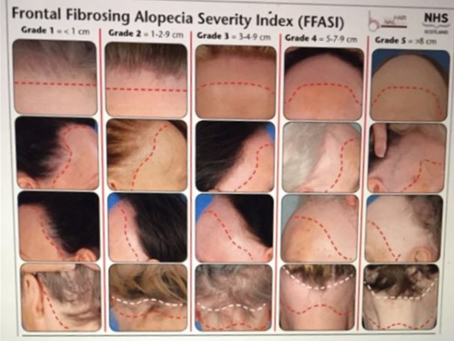 Using PRP as a Trichologist to Fight Scarring Alopecia