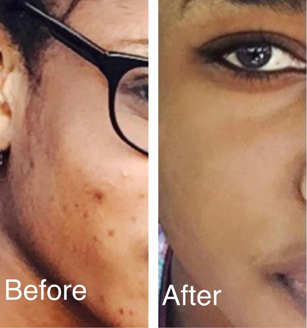 Thumbnail: Before and after image showing the transformation of skin with the use of Nouvel products. The 'before' shows acne, dark spot