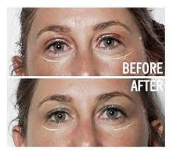 Access Facelift Body Process