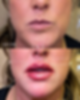 russian lip filler, lip filler, dermal filler, botox, neurotoxin, facial balancing, youthful, fat dissolver