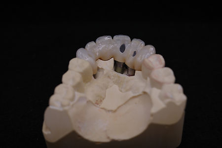 Completed detal implant restoration