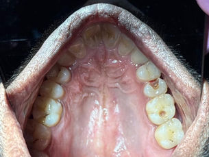 Dental examination revealing multiple cavities on the upper molars, highlighting the need for dental care and treatment.