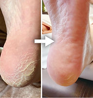 足裏の角質ケアコース