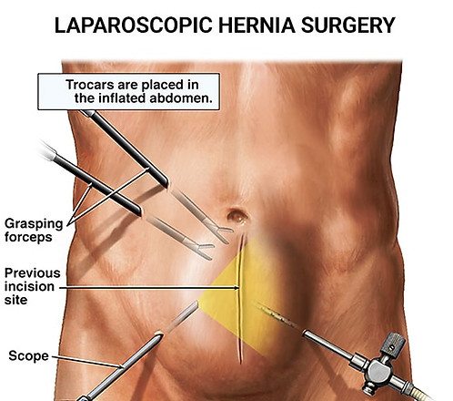 laparoscopic-hernia-surgery-1-2.jpg