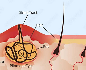 Pilonidal-Sinus.webp