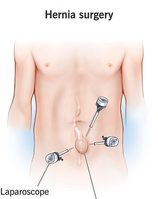 17967-hernia-surgery.jpg