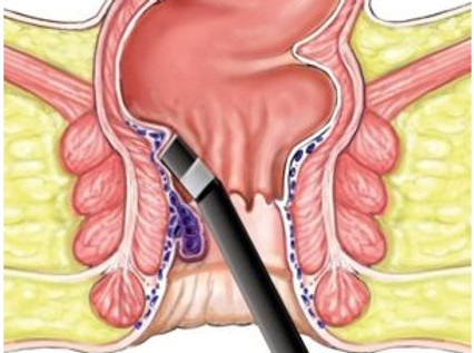 Advanced-Laser-Treatment-Anal-Fissures.jpg