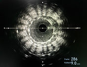 Intravascular ultrasound imaging (IVUS) ADOM