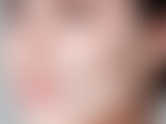 Myths and prejudices associated with APTOS thread lifting