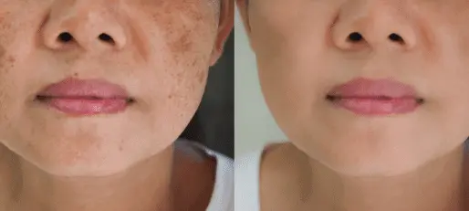 Top anti-pigmentation treatments