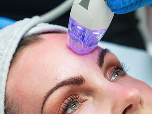 RF microneedling treatment procedure on face
