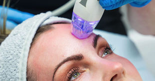 RF microneedling treatment procedure on face