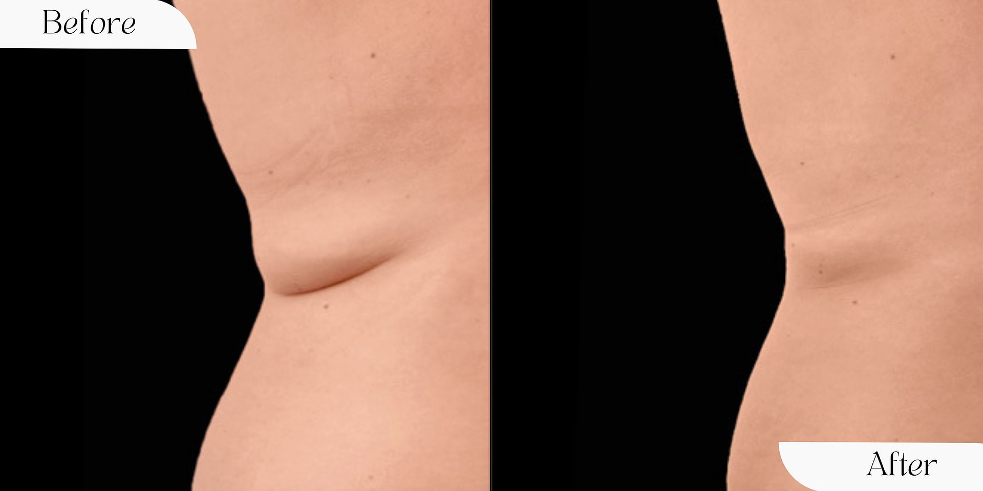 Before and after visuals demonstrating remarkable body contouring and skin tightening achieved with the Exion Body Applicator by BTL Aesthetics.