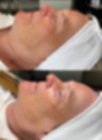 Before and after eines Circadia firming Peptide Mask Treatments.