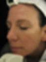 Haut vor der Hydrafacial Deluxe Behandlung.