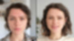 Vorher- Nachherbild eines Oxygen RX Treatments mit erfolgreicher Akne-Behandlung.