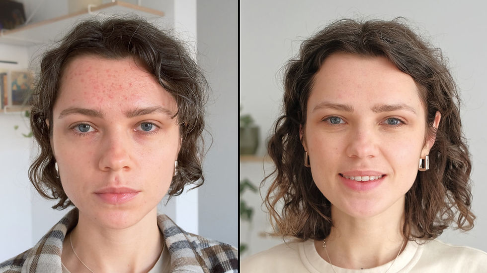 Vorher- Nachherbild eines Oxygen RX Treatments mit erfolgreicher Akne-Behandlung.