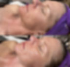 Vorher- und Nachherbild einer Dermaplaning beyond Botox Behandlung.