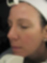 Haut nach der Hydrafacial Deluxe Behandlung.