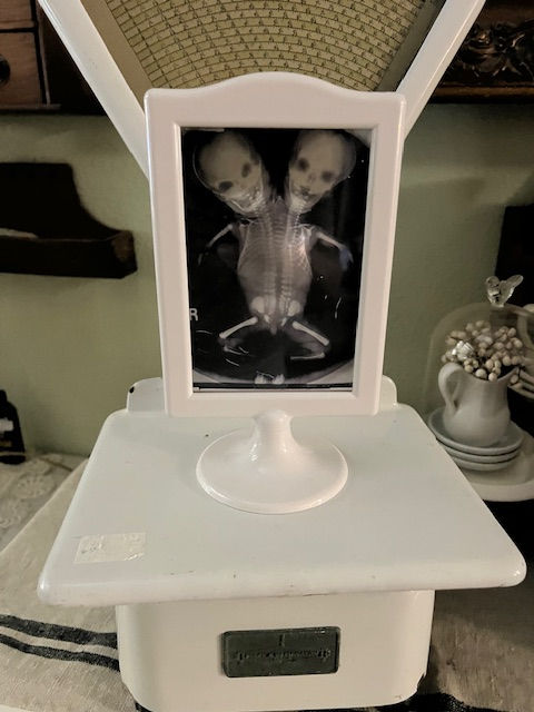 Vintage Conjoined Twin X-Ray