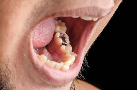 mouth with amalgam filling