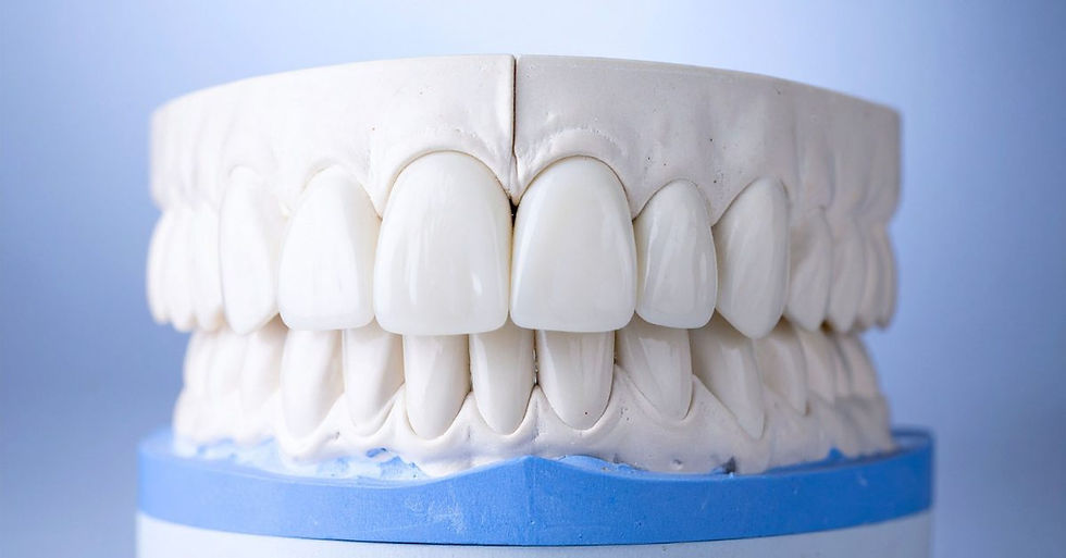 Composite Bonding vs Veneers Mould