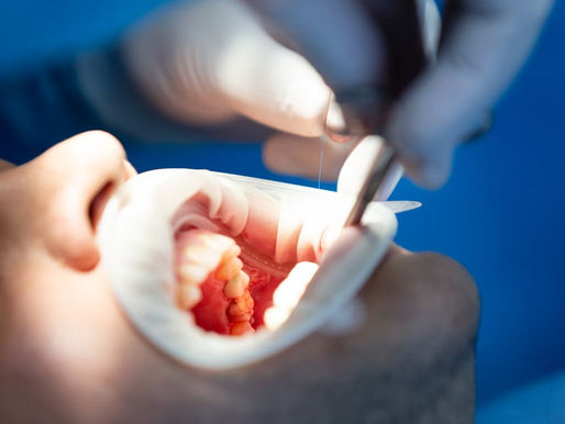 root canal treatment