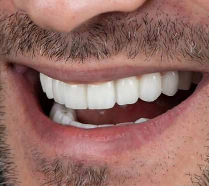 man showing off the results of his composite teeth bonding