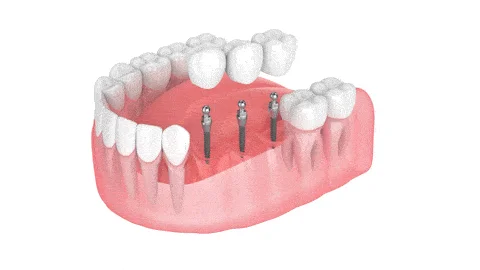 dental bridge illustration