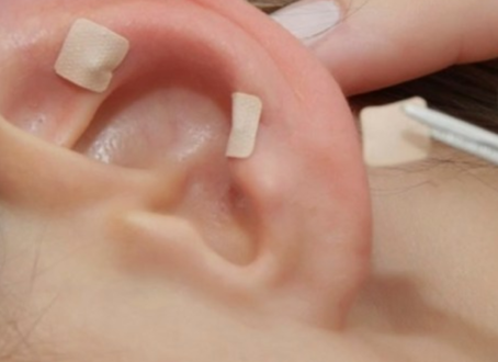 AURICULOTERAPIA E DTM