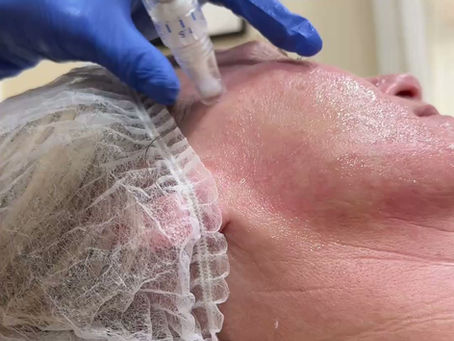 SkinPen Explained